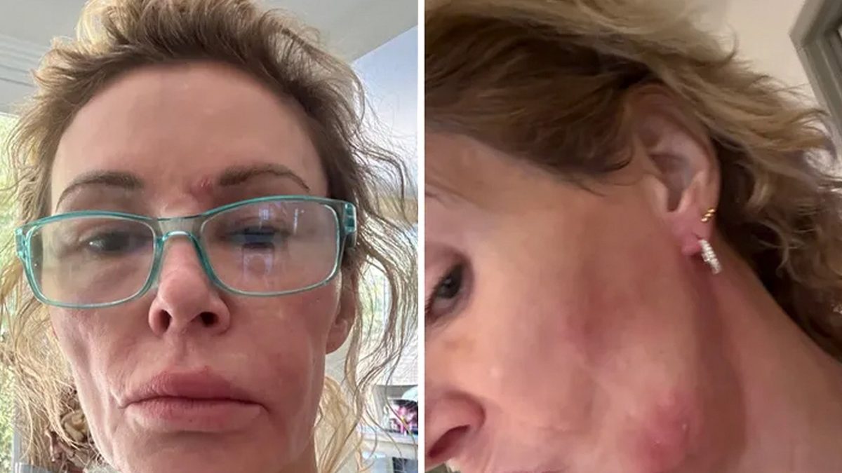 Brandi Glanville Faces Fungal Ball, Bacterial Attack—Fans Rally for Care